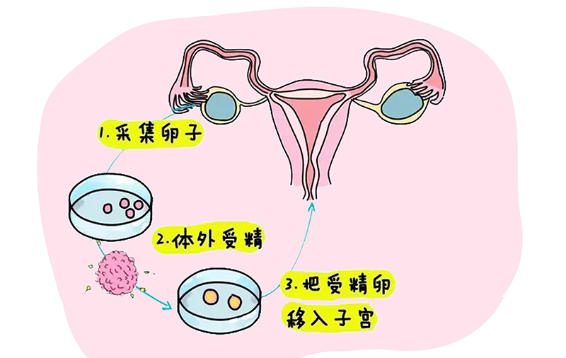 辅助生殖:供卵代怀婴儿性别选择、费用与机构指南